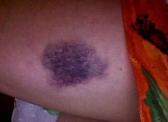 bruise2.jpg